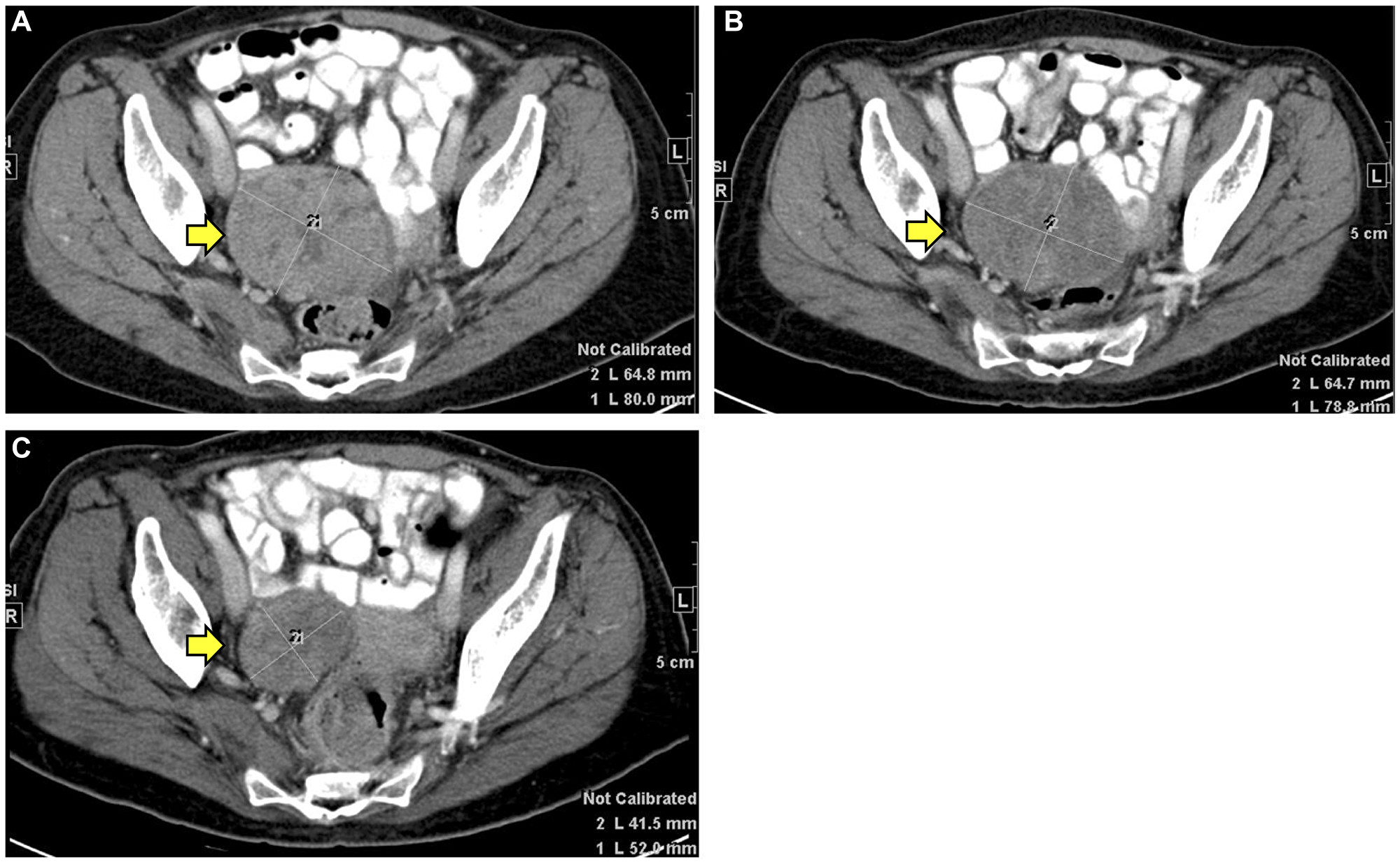 CT imaging findings of patient #9