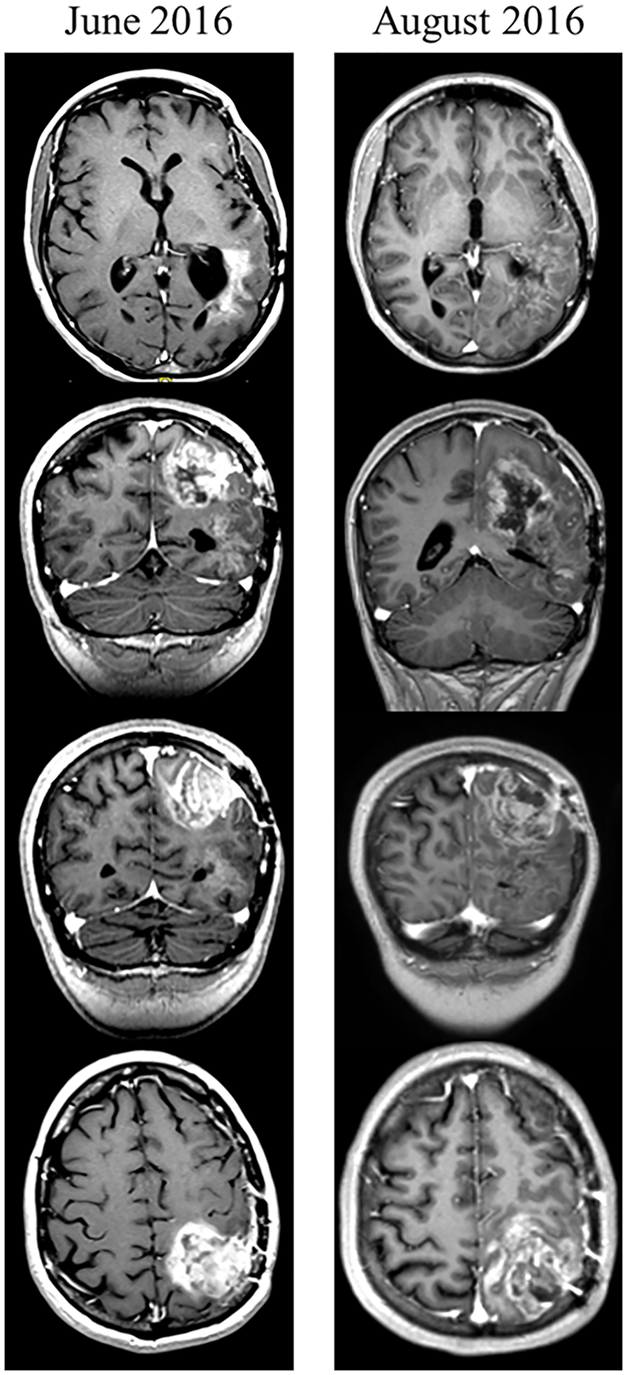 Clinical response to GBMF – representative images