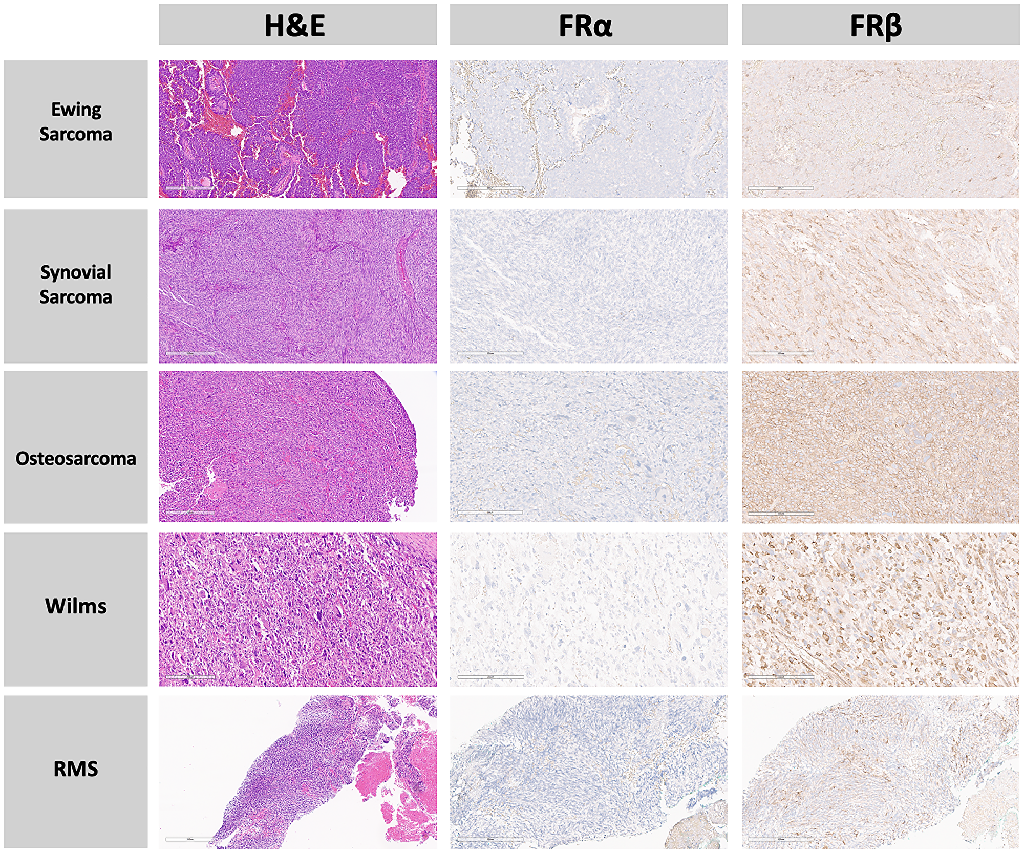 Panel of various pediatric tumors comparing H&amp;E staining, FRα, and FRβ protein expression within the tumor