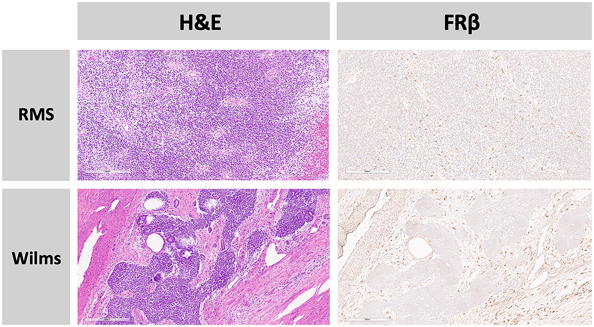 FRβ protein expression in the tumor micro-environment alone