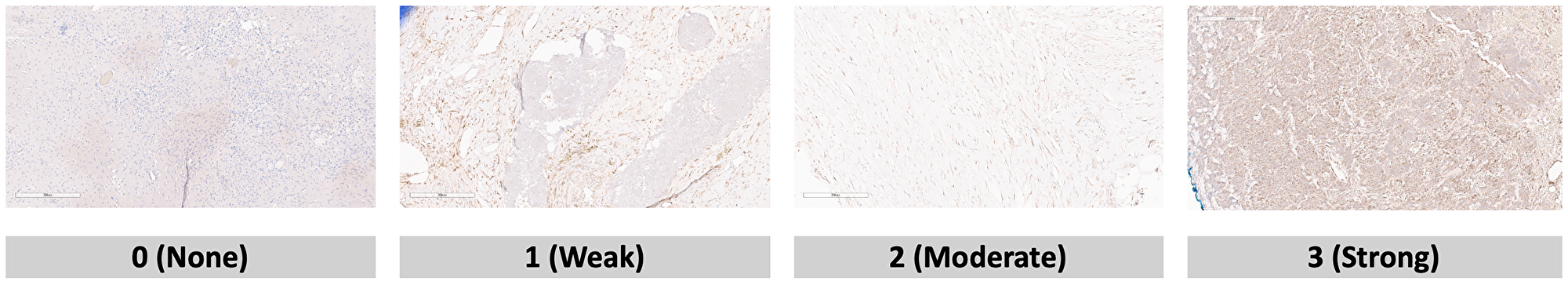 Slide scoring system created to quantify immunostaining intensity