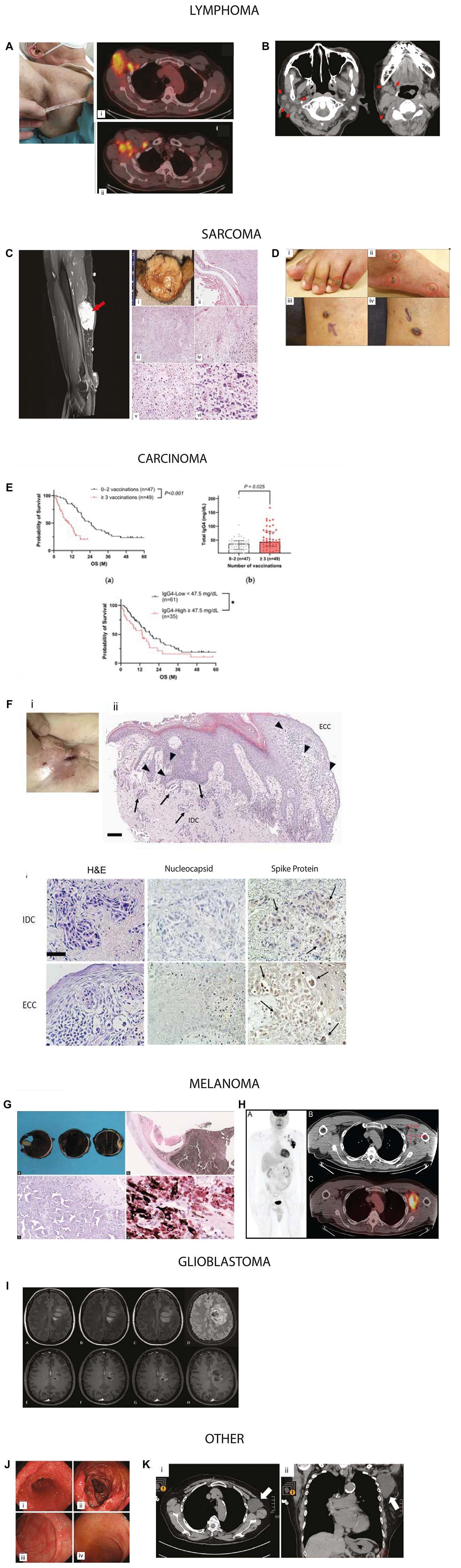 Representative examples of cancers reported in temporal association with COVID-19 vaccination