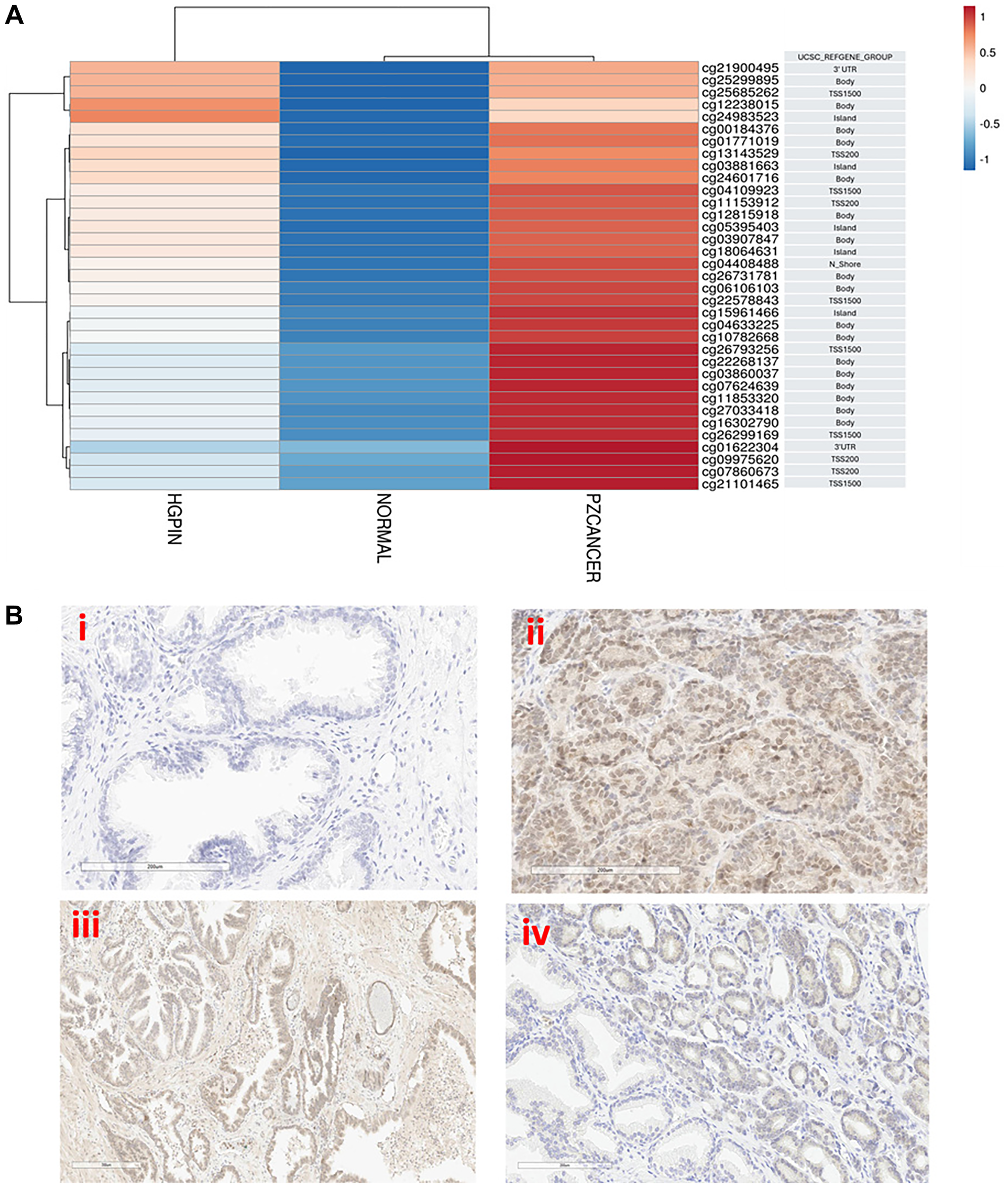 (A) DNA methylation and immunohistochemical analysis of PDX1 in prostate tissues. (A) Heat map analysis compares the methylation level of unique CpG probe-sets of PDX1 genome in Illumina 450K genome-wide DNA methylation array dataset in pre-cancerous lesion HGPIN, Normal and Prostate Cancer (PZCancer) tissues. Data shows beta (β)-values expressed as log10β-value (FDR adjusted; p $!--ESC