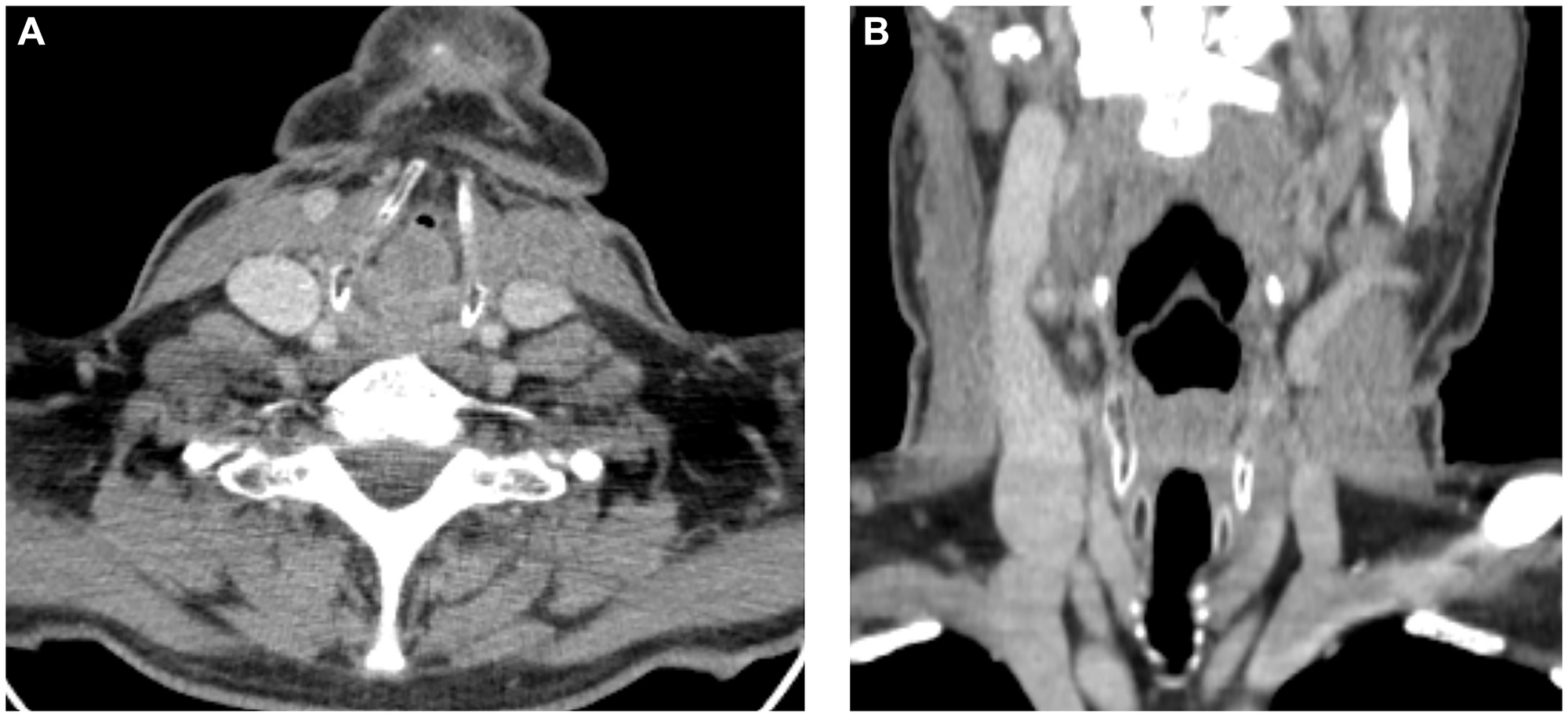 CT images in the axial (A) and coronal (B) planes demonstrate a tumor formation of the larynx, subtotally filling the lumen of the larynx.