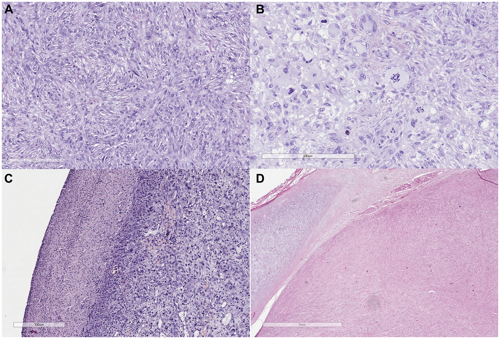 (A) Tumor growth is represented by the proliferation of cellular intersecting bundles of spindle-shaped cells with bright eosinophilic cytoplasm and elongated blunt-ended (cigar-shaped) nuclei, in places with the formation of a moire pattern (HE, x20). (B) Cell pleomorphism, pathological mitoses (HEx40). (C) Tumor surface with ulceration (HE, x20). (D) Tumor growth at the border with the laryngeal cartilage (HE, x20).