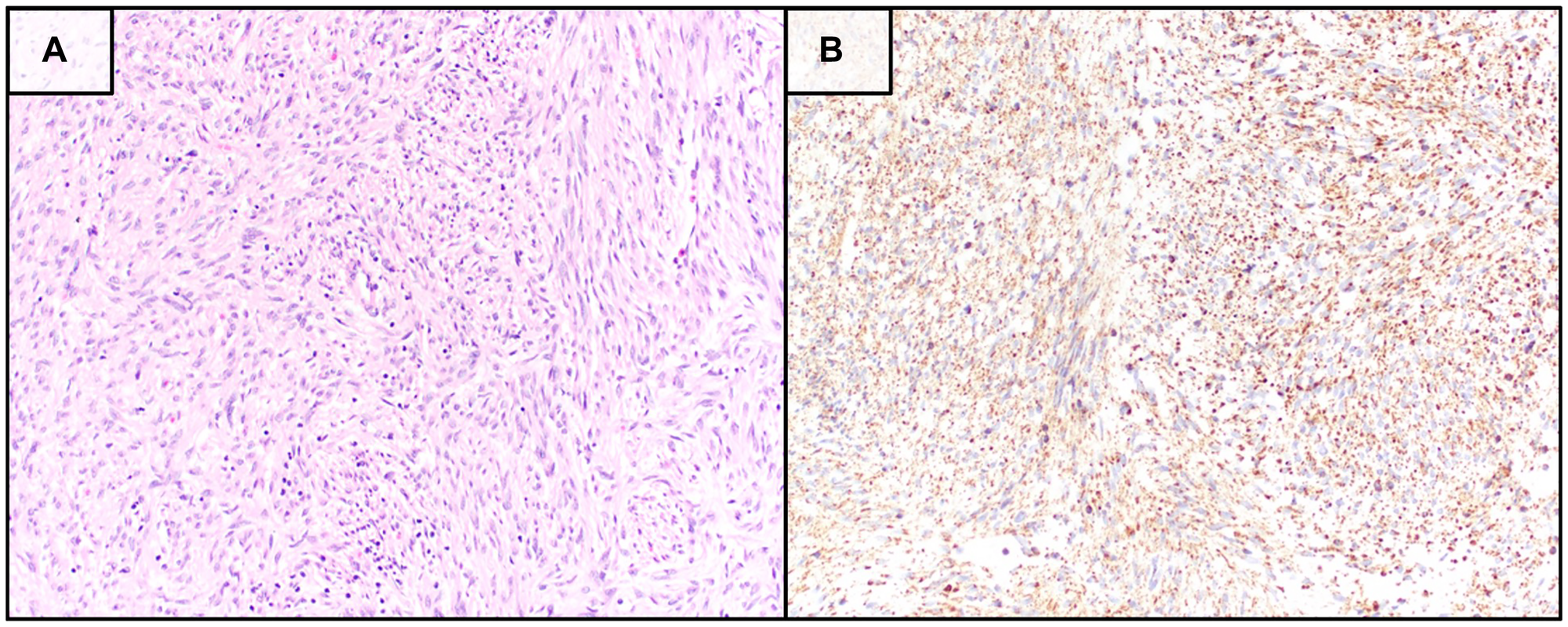 Histopathologic and immunohistochemical features of the tumor biopsy