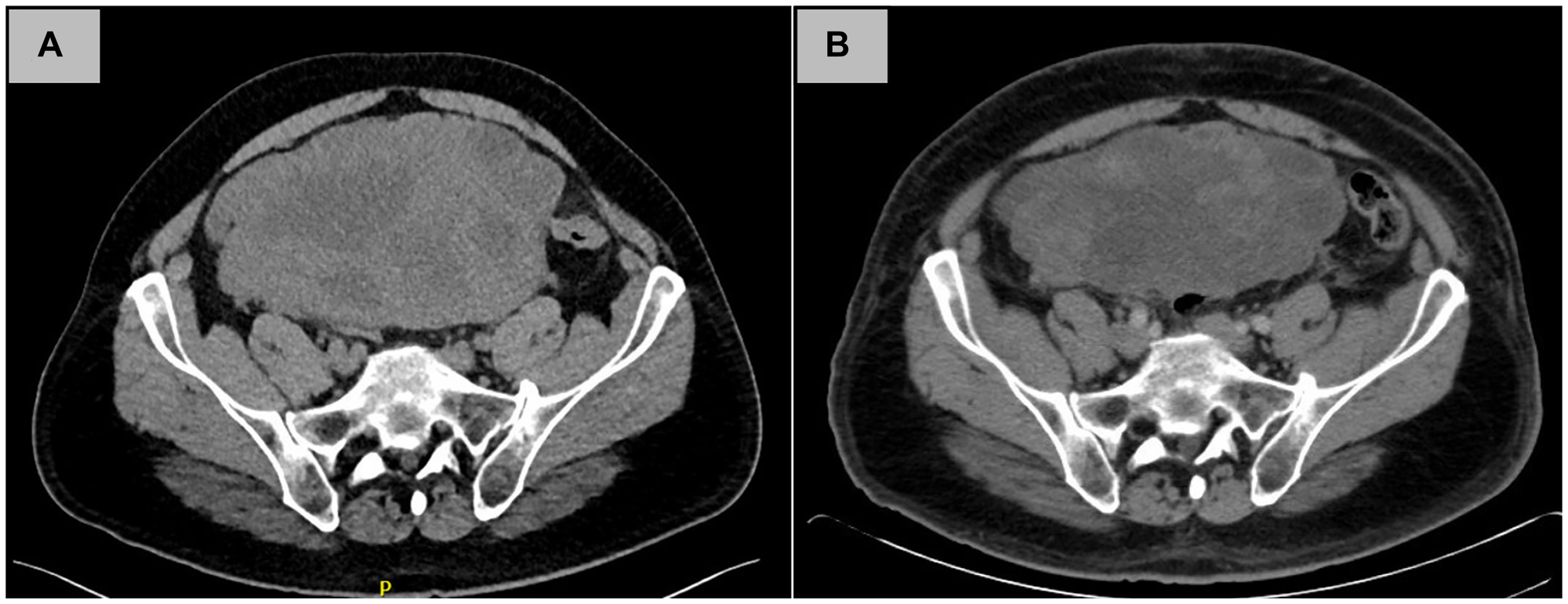 Radiographic tumor response to neoadjuvant imatinib therapy