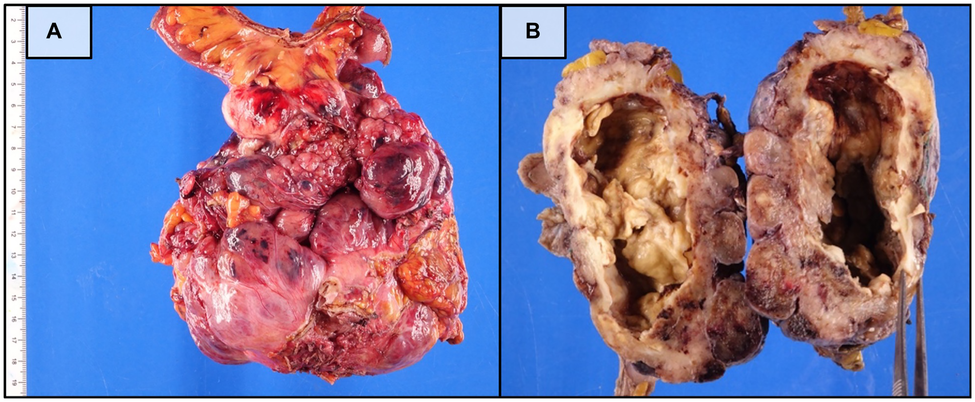 Gross pathologic features of the surgically resected small bowel GIST