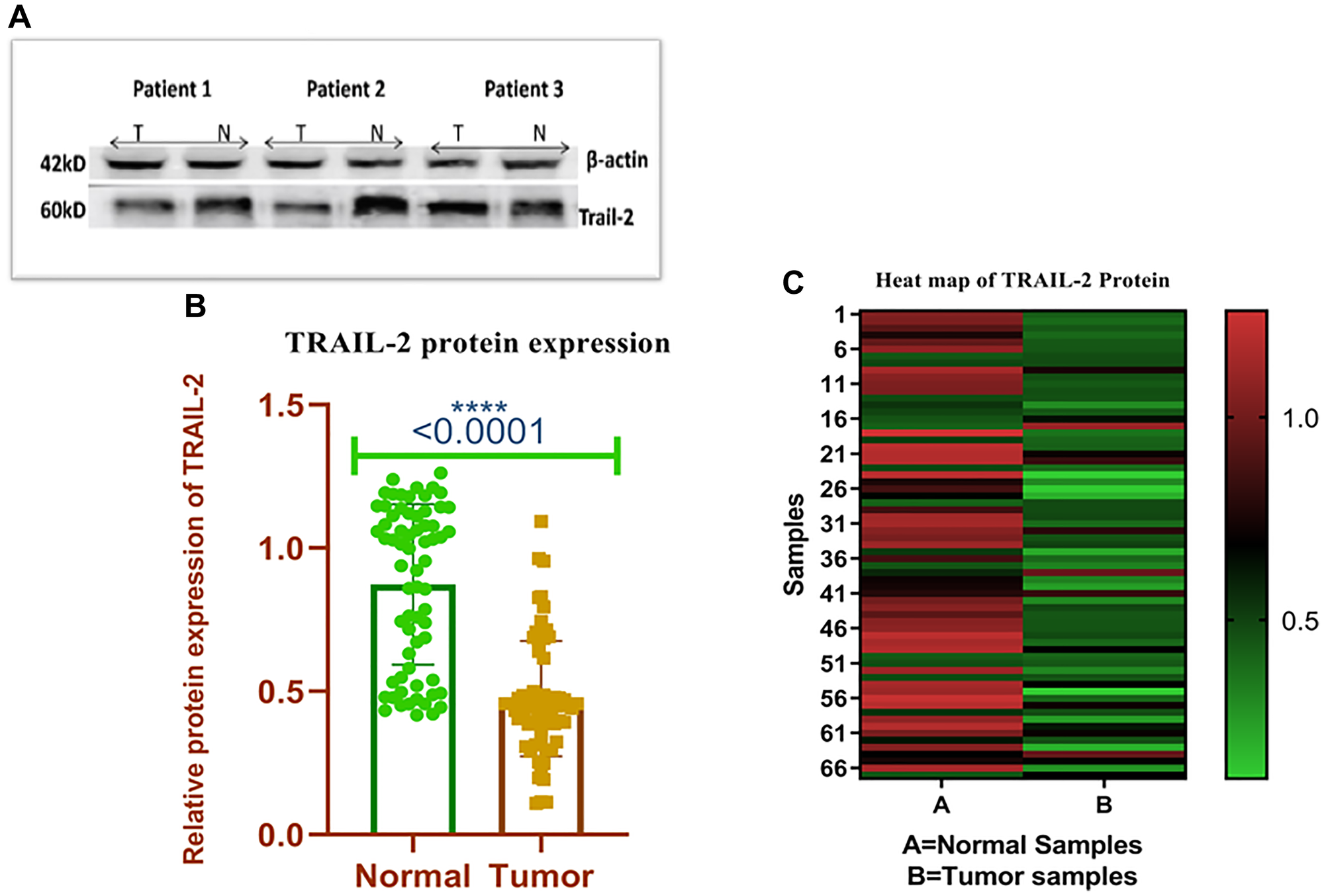 (A) The representative western blots show the expression of TRAIL-R2 protein using (Specific antibodies and corresponding loading control β-actin. N represents the protein from the normal site and T represents the protein from tumor site. (B) Relative Protein expression of TRAIL-R2 receptor in breast tumor and adjacent normal tissues. (C) Heat map plot (analysed by graph pad prism version 8.0.2) of TRAIL-R2 protein relative expression (fold change) in breast cancer cases and adjacent normal tissues.