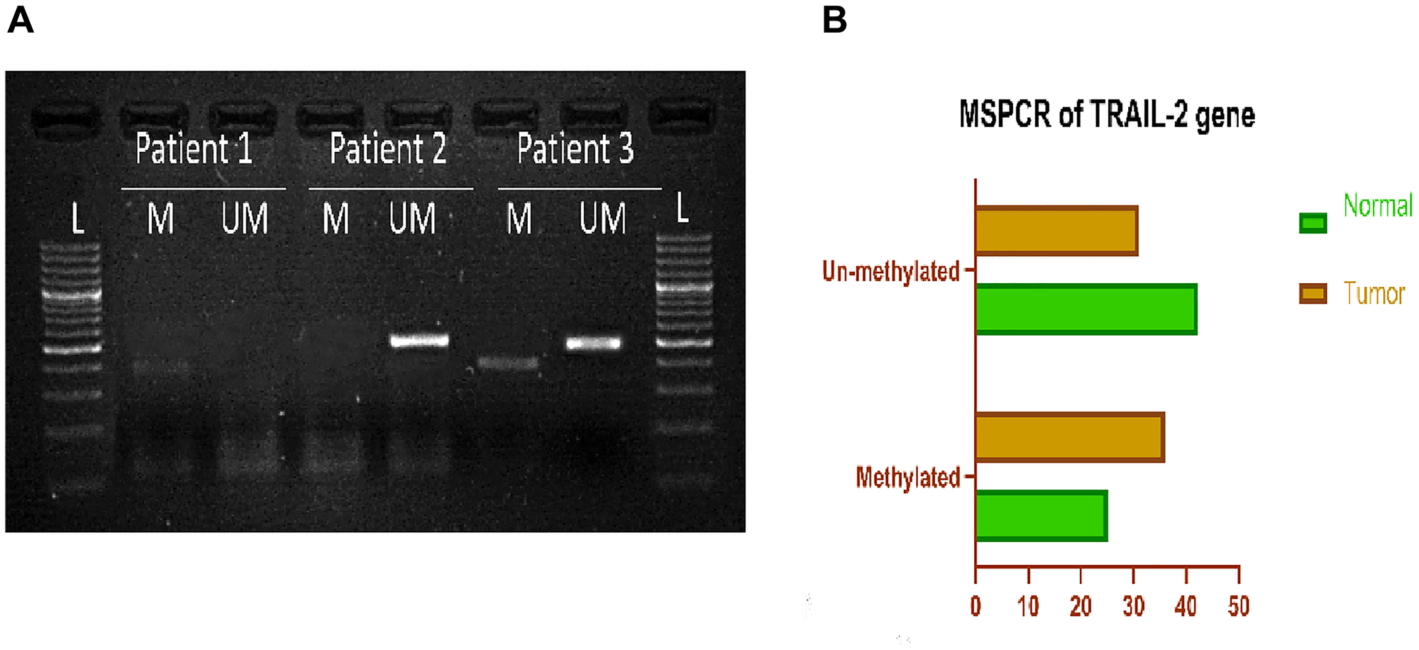 (A) Representative gel picture of Methylation-specific PCR analysis of TRAIL-2 gene in Breast cancer patients: DNA methylation was assessed using two specifically designed primers to amplify either methylated DNA (M,386bp), or unmethylated DNA (UM,498bp). (Abbreviations: L: 100 bp DNA ladder; N: normal tissue; T: tumor tissue). (B) Graphical representation of Methylation specific PCR of TRAIL-2 gene, showing percentage of methylated and unmethylated samples in breast cancer tissue and adjacent normal tissue.