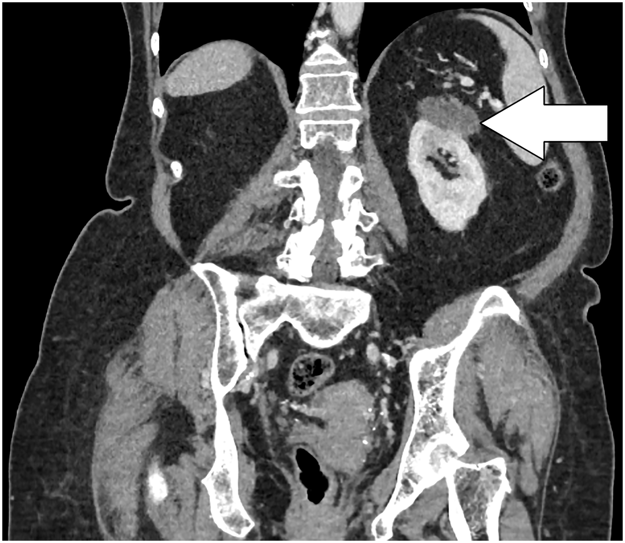 Coronal CT scan of the abdomen with intravenous contrast demonstrating a hypodense lesion measuring 55 × 34 mm arising from the upper of the left kidney