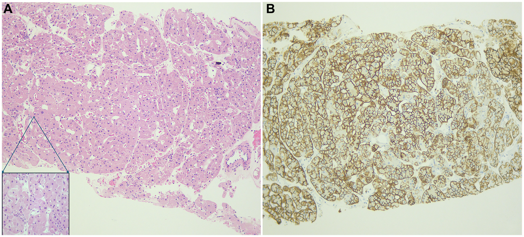 Histopathologic examination demonstrates cells with distinct cell borders, eosinophilic cytoplasm, and uniformly small-sized nuclei, without perinuclear clear halo, significant atypia, or an increased number of mitoses (hematoxylin–eosin, ×10 magnification; (A)). A boxed inset in the lower left of panel A highlights the tumor cells at higher magnification (×40). The cells stain positive for E-cadherin (×10 magnification; (B)).