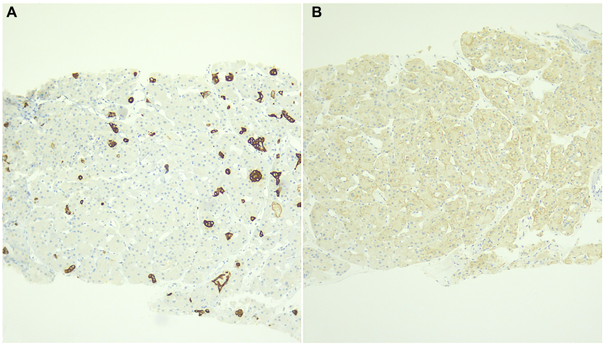 Immunohistochemical examination (X10 magnification) reveals focal positive staining for CK7 (A) and negative staining for CD117 (B).